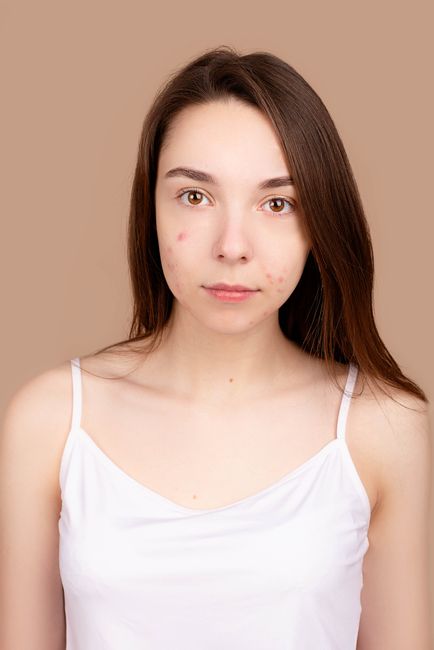 美麗佳人,Marie Claire,痘痘貼,rhode 焦糖香蕉護唇精華